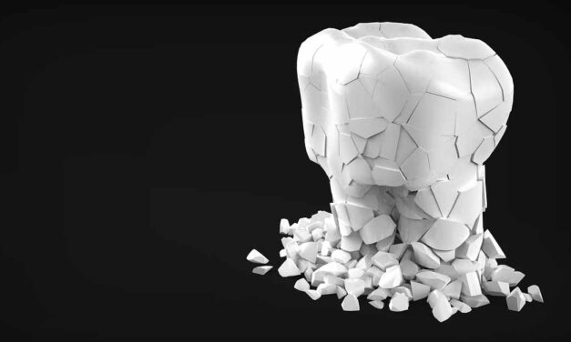 Tipos de retenedores dentales y cómo elegir el adecuado