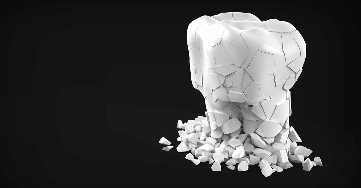 Tipos de retenedores dentales y cómo elegir el adecuado